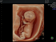 妊娠10週台 3D4Dイメージ1