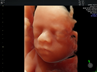 妊娠20週台 3D4Dイメージ1